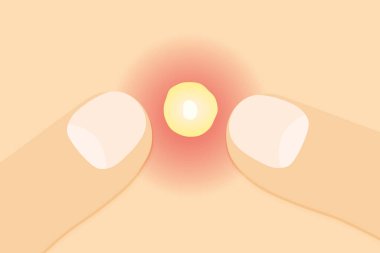 parmaklar pimple- vektör illüstrasyonunu sıkıştırıyor