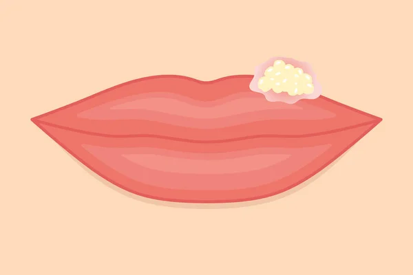 Female Lips Infected Herpes Virus Vector Illustration — Stock Vector