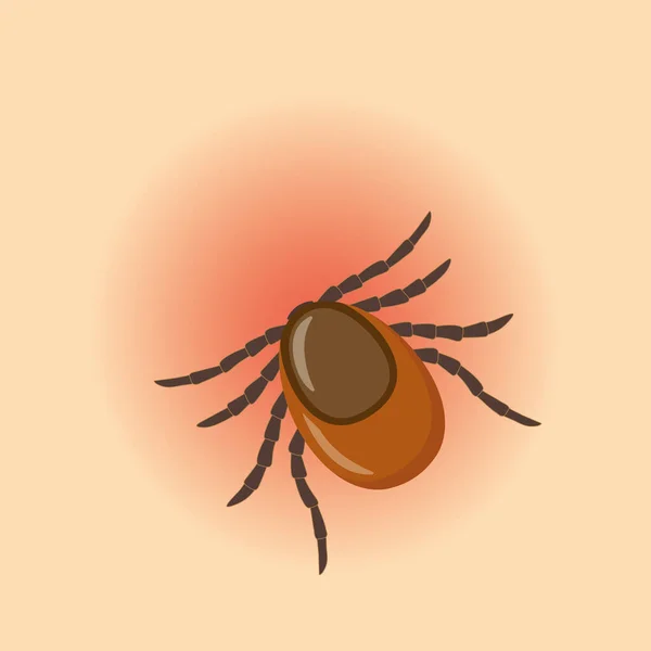 stock vector tick sticking in human skin, risk of infection of lyme and  tick-borne disease -vector illustration