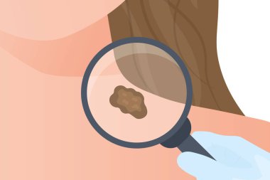 Doktor büyüteç altında köstebeği kontrol eder; melanom cilt kanseri önleme - vektör çizelgesi