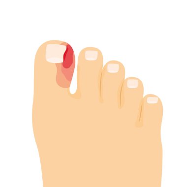 ingrown toenail, paronychia of the toe- vector illustration clipart