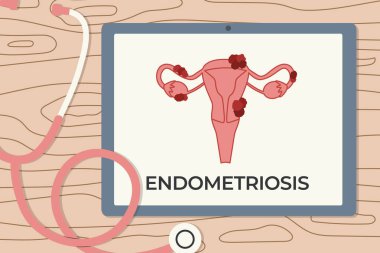 Endometriyozis hastalığını gösteren dijital tablet; tıbbi ve eğitim içeriği; farkındalık, endometriyozis konsepti tanısı - vektör illüstrasyonu