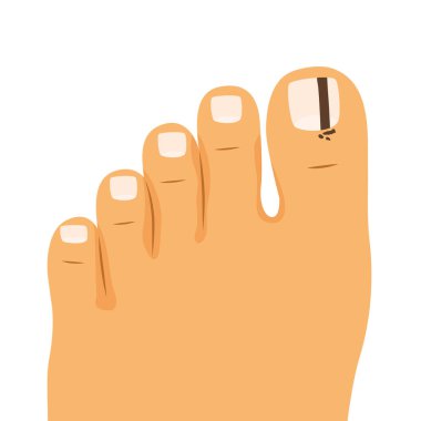 Ayak tırnağı melanomdan etkilenir. Dermatoloji farkındalığı, cilt kanseri önleme materyalleri ve sağlık hizmetleri sunumları için eğitici tıbbi grafik ideali.