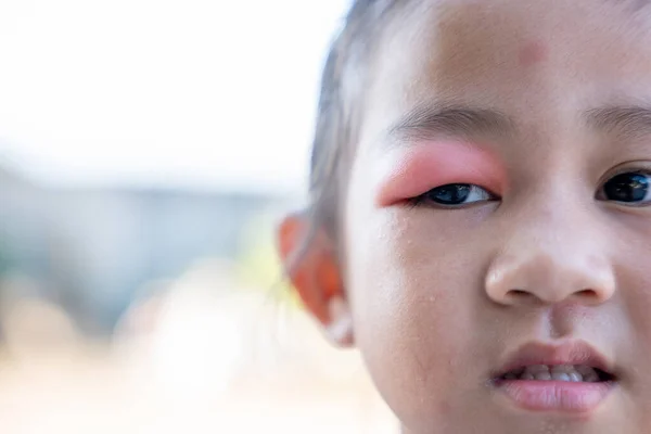 Stye Eye Diseases Closed Asian Kid Little Girl Eye Sty — Stock Photo, Image