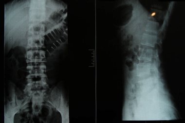  x-ray spine medicine man healthy