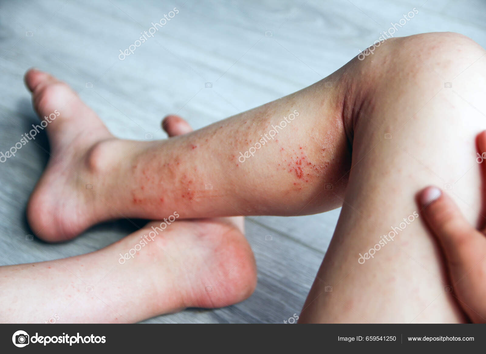 Dermatite Atópica Nas Pernas Tratamento Infantil — Foto © Kostia777  #659541250, image size:1600x1167