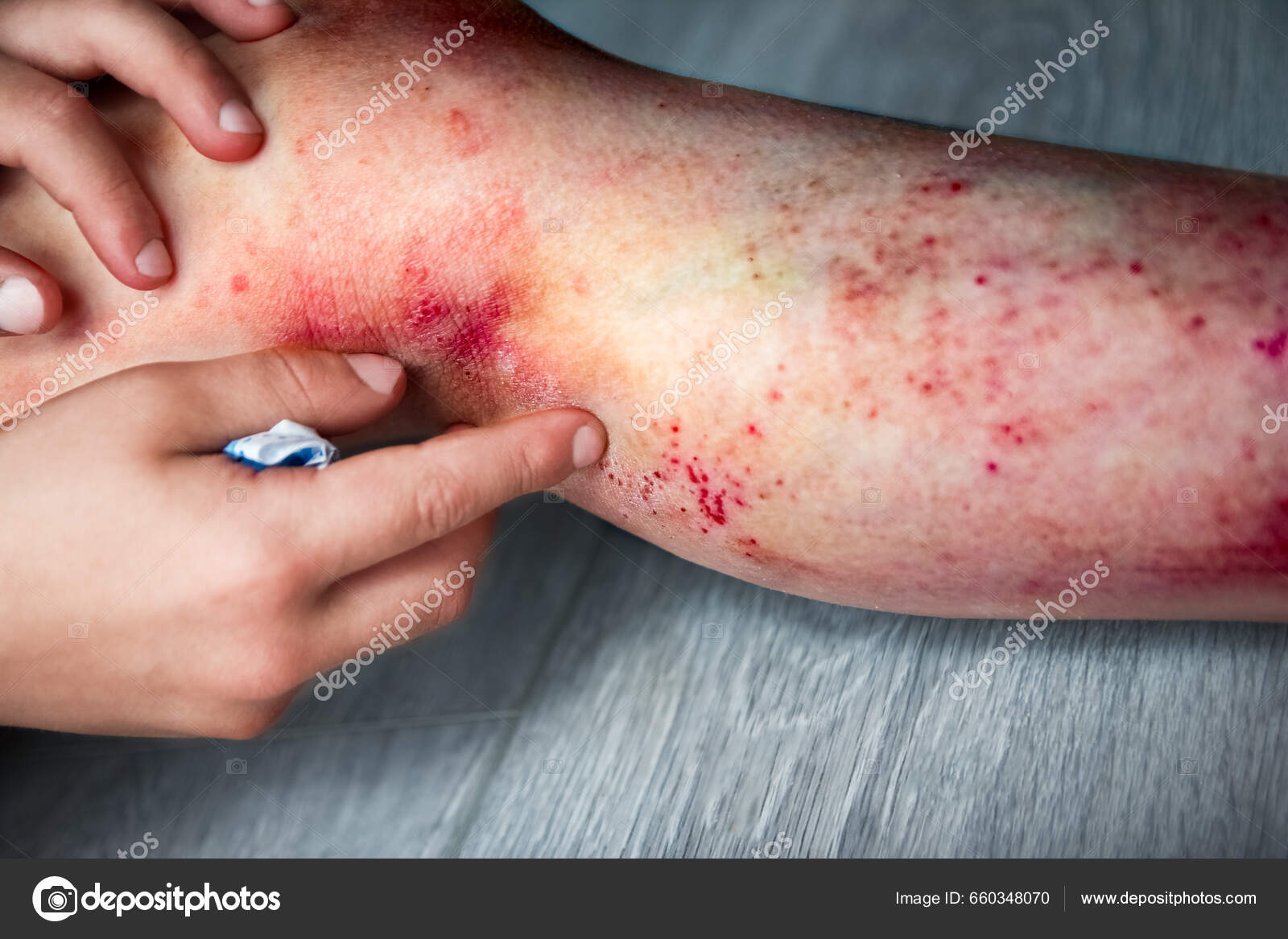 Atopic Dermatitis Legs Child Treatment — Stock Photo © Kostia777 #660348070, image size:1600x1167