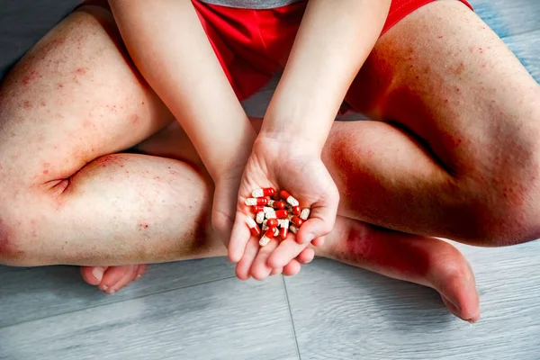 Dermatite Atópica Nas Pernas Tratamento Infantil — Fotografia de Stock