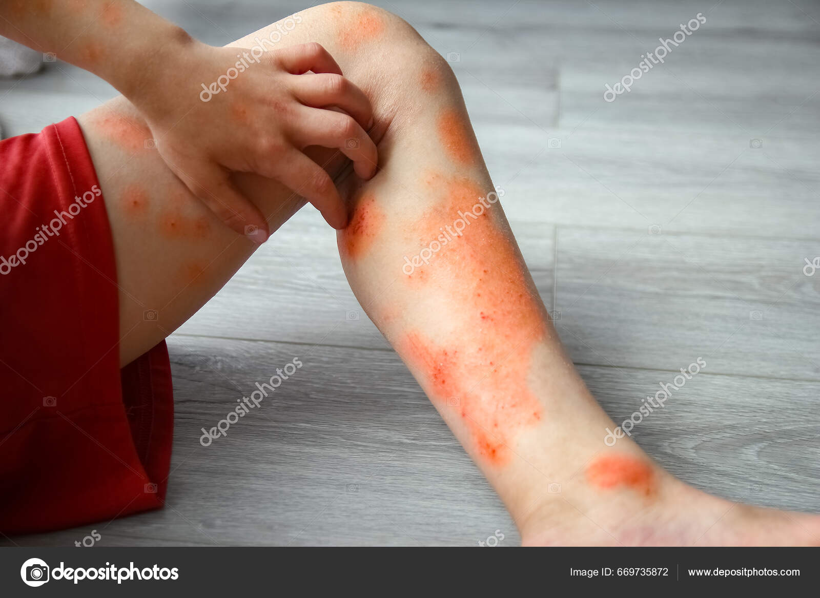 Dermatite Atópica Nas Pernas Tratamento Infantil — Foto © Kostia777  #669735872, image size:1600x1167