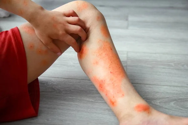 Atopic Dermatitis Legs Child Treatment — Stock Photo, Image