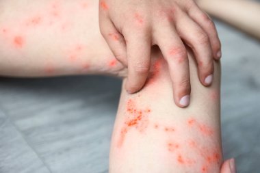 Çocuk tedavisinin bacaklarında atopik dermatit