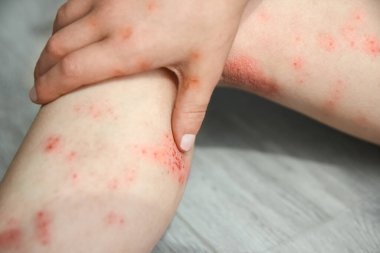 Çocuk tedavisinin bacaklarında atopik dermatit