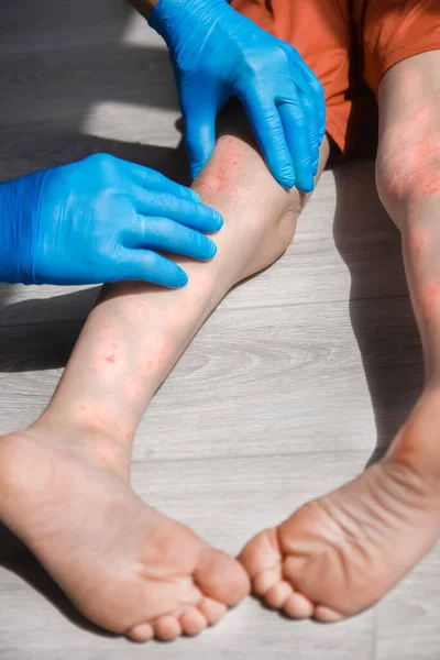 Atopic Dermatitis Legs Child Treatment — Stock Photo, Image