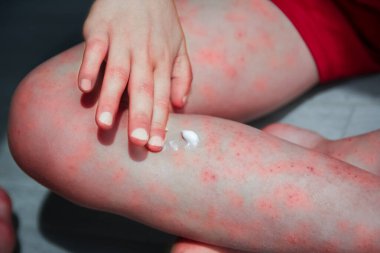 Çocuk tedavisinin bacaklarında atopik dermatit