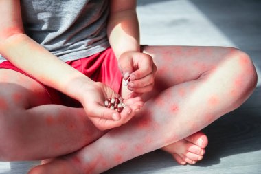 Çocuk tedavisinin bacaklarında atopik dermatit