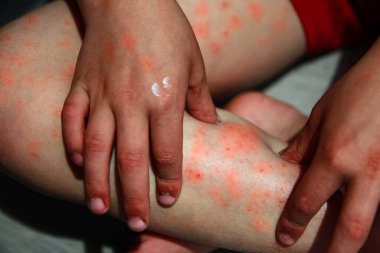 Çocuk tedavisinin bacaklarında atopik dermatit