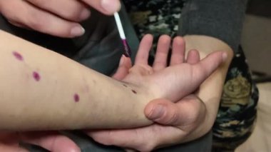 Bir çocuk hastalığı cilt döküntüsü salgını.