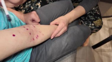 Bir çocuk hastalığı cilt döküntüsü salgını.