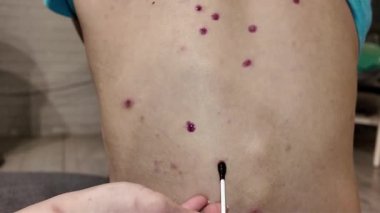 Bir çocuk hastalığı cilt döküntüsü salgını.