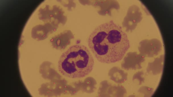 Клітини Крові Людини Під Мікроскопом Аномальні Клітини Крові Огляд Рідини — стокове відео