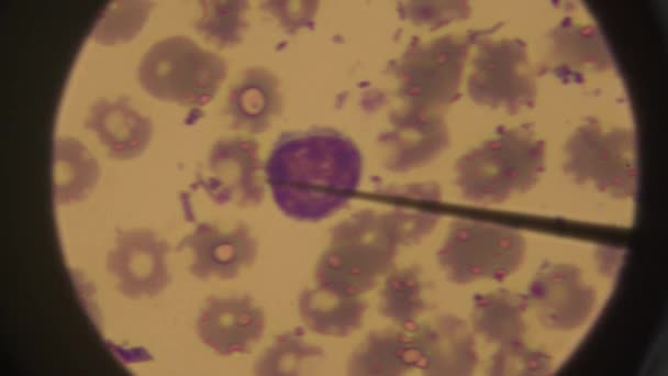Крупный План Клеток Крови Микроскопом Аномальные Клетки Крови Обследование Жидкости — стоковое видео