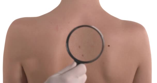 Inspección Lunares Piel Espalda Mujer Caucásica Con Lupa Doctor Encuentra — Vídeo de stock