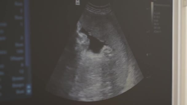 Nahaufnahme Einer Ultraschalluntersuchung Eines Babys Fötus Anatomie Scan Monitor Des — Stockvideo