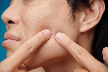 Yüzü yıkadıktan sonra sivilceleri sıkan adamın yakın plan görüntüsü.