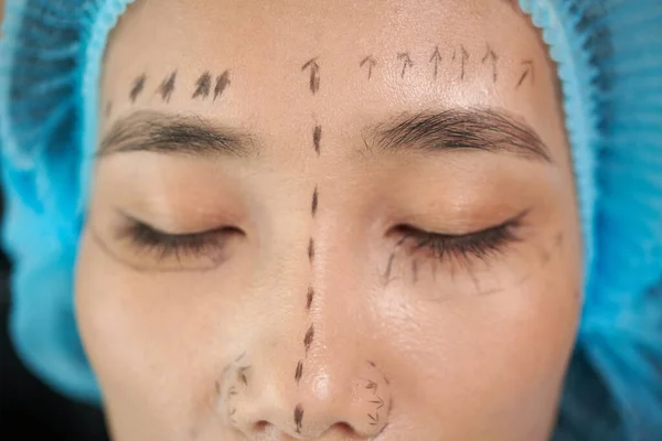 Face of young Asian woman with marks for facelift