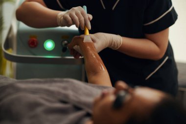 Kozmetik uzmanı lazer epilasyonu için koluna jel sürüyor.