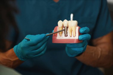 Mavi önlük ve eldiven giyen dişçi plastik diş modelini kullanarak diş implantı işlemini açıklıyor. Metal implant ve doğal dişler modelde sergilenir