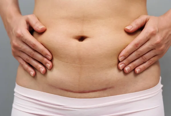 Sezaryen yarası olan bir kadının karnını kapatın. 