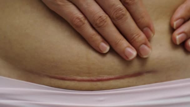 剖腹产疤痕为剖腹产的妇女闭腹 — 图库视频影像