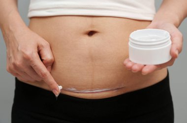 woman putting healing cream in the c-section scar of cesarean clipart