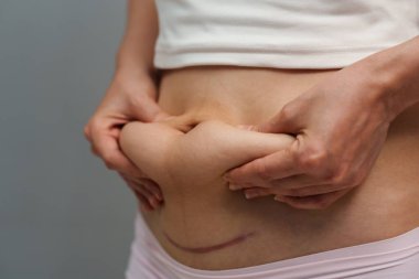 woman grabs and pinches her postpartum belly fat and a c-section scar of caesarean  clipart