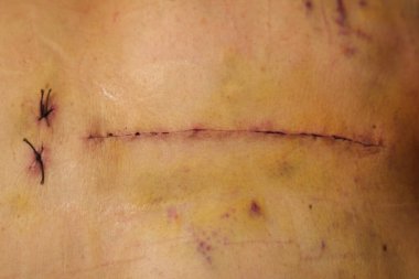 Kadın vücudundaki açık kalp ameliyatından dolayı yara (Kalp kapakçığı regurjitasyonu)