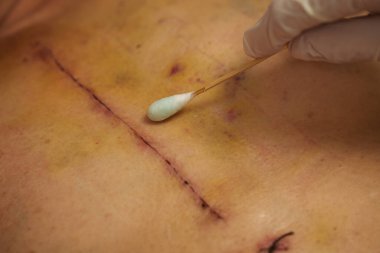 Doktor, kadın vücudundaki açık kalp ameliyatından kaynaklanan alkol ve pamuk tomurcuk temizleme yarasını kullanarak (Kalp kapakçığı regurjitasyonu))