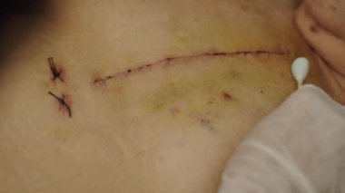 Doktor, kadın vücudundaki açık kalp ameliyatından kaynaklanan alkol ve pamuk tomurcuk temizleme yarasını kullanarak (Kalp kapakçığı regurjitasyonu))