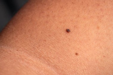 Cilt muayenelerinin sağlık sorunlarını erken tespit etmedeki önemini araştırın.