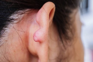 Sağlık hizmetleri anlayışını vurgulayan kulak kisti temizleme prosedürünün yakın plan görüntüsü.