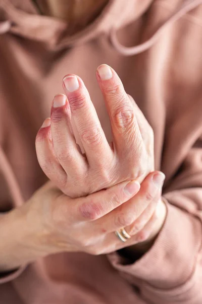 Close Elder Woman Hands Atopic Dermatitis Eczema Allergy Reaction Dry — Stock Photo, Image