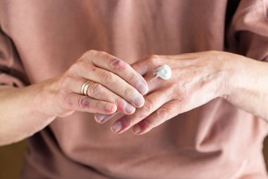 Elder woman applying moisturizing cream or ointment to her hands with atopic dermatitis, eczema, allergy reaction on dry skin