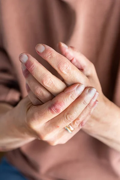 Close Elder Woman Hands Atopic Dermatitis Eczema Allergy Reaction Dry — Stock Photo, Image