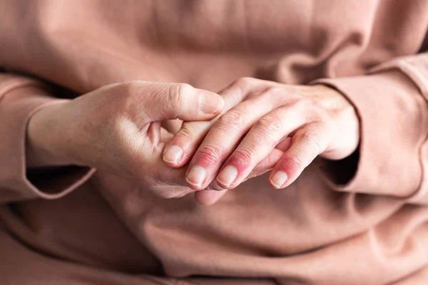 Close Mãos Mulher Mais Velha Com Dermatite Atópica Eczema Reação — Fotografia de Stock