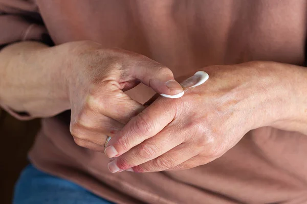 Elder Woman Applying Moisturizing Cream Ointment Her Hands Atopic Dermatitis — Stok fotoğraf