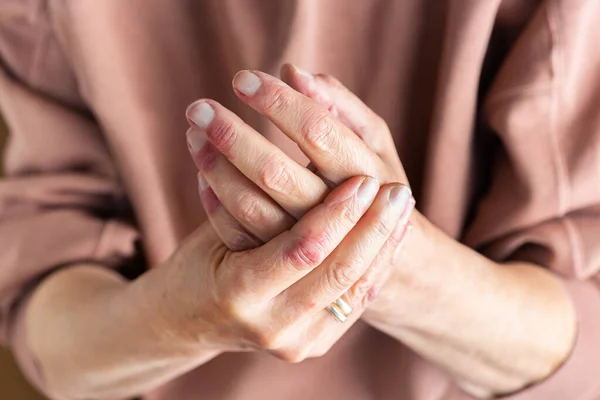Close Mãos Mulher Mais Velha Com Dermatite Atópica Eczema Reação — Fotografia de Stock