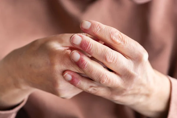 老年妇女手部有特应性皮炎 干性皮肤过敏反应的近视 — 图库照片