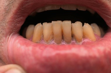 Uygunsuz ısırıklara bağlı yıpranmış diş örnekleri. Diş sorunları..