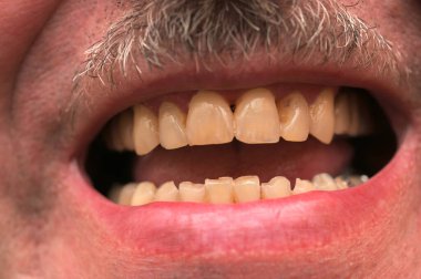 Uygunsuz ısırıklara bağlı yıpranmış diş örnekleri. Diş sorunları..