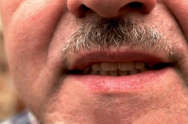 Uygunsuz ısırıklara bağlı yıpranmış diş örnekleri. Diş sorunları..